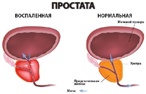 προστάτης